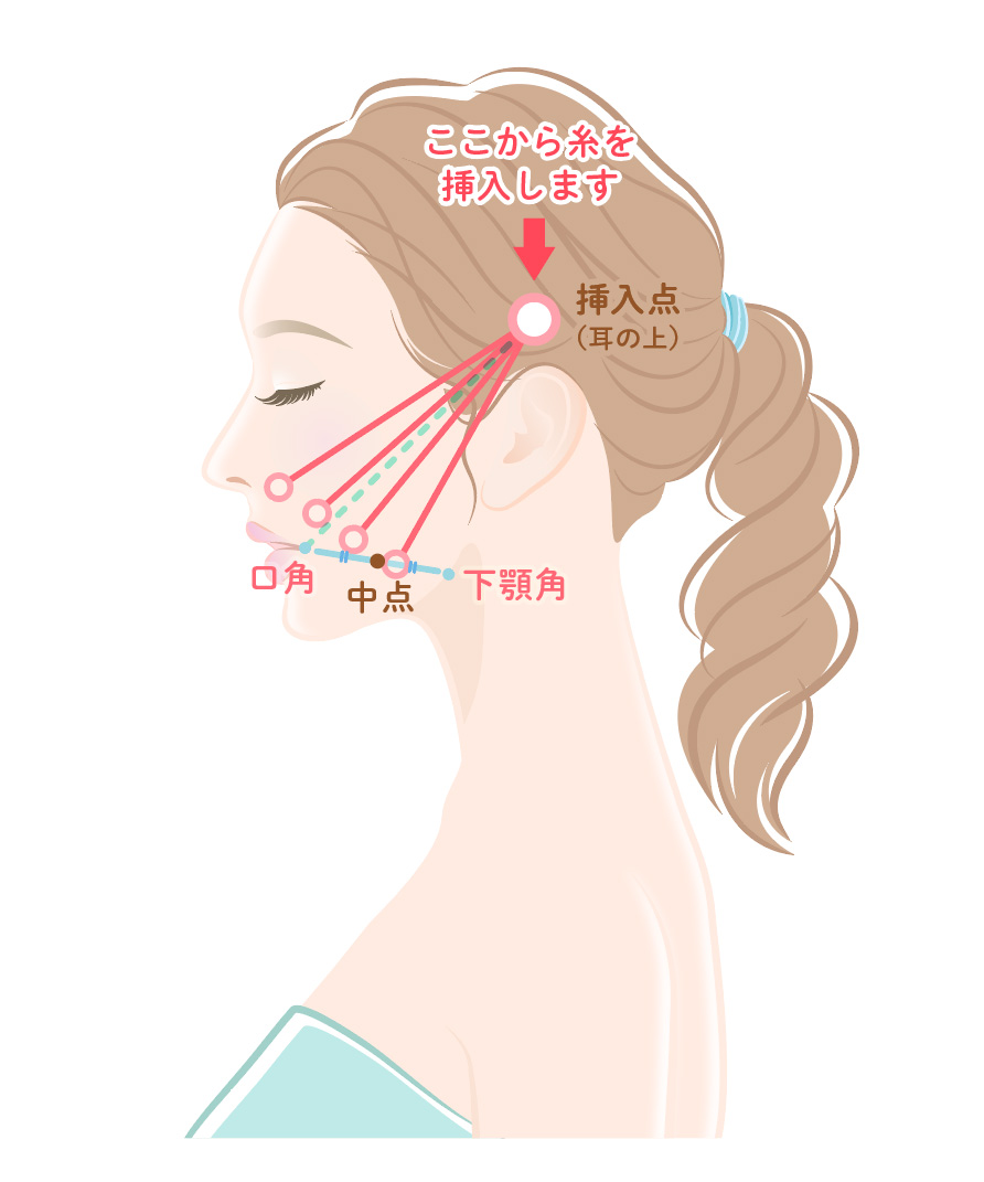 大津市の美容皮膚科｜ぜぜ駅前ひふ科・形成外科クリニックの糸リフトのイメージ図