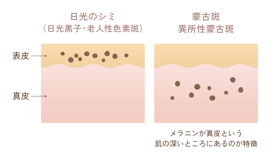 日光のシミと異所性蒙古斑の肌比較