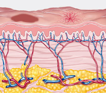滋賀県大津市・草津市でフォトフェイシャルステラM22(IPL)を提供しているぜぜ駅前ひふ科・形成外科クリニックの照射説明図(照射前)